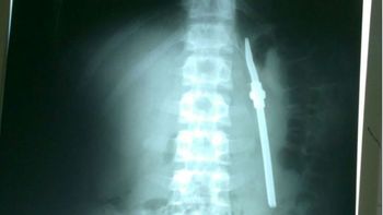 un preso tomaba mate y se trago una bombilla: creen que lo hizo para fugarse un preso tomaba mate y se trago una bombilla: creen que lo hizo para fugarse