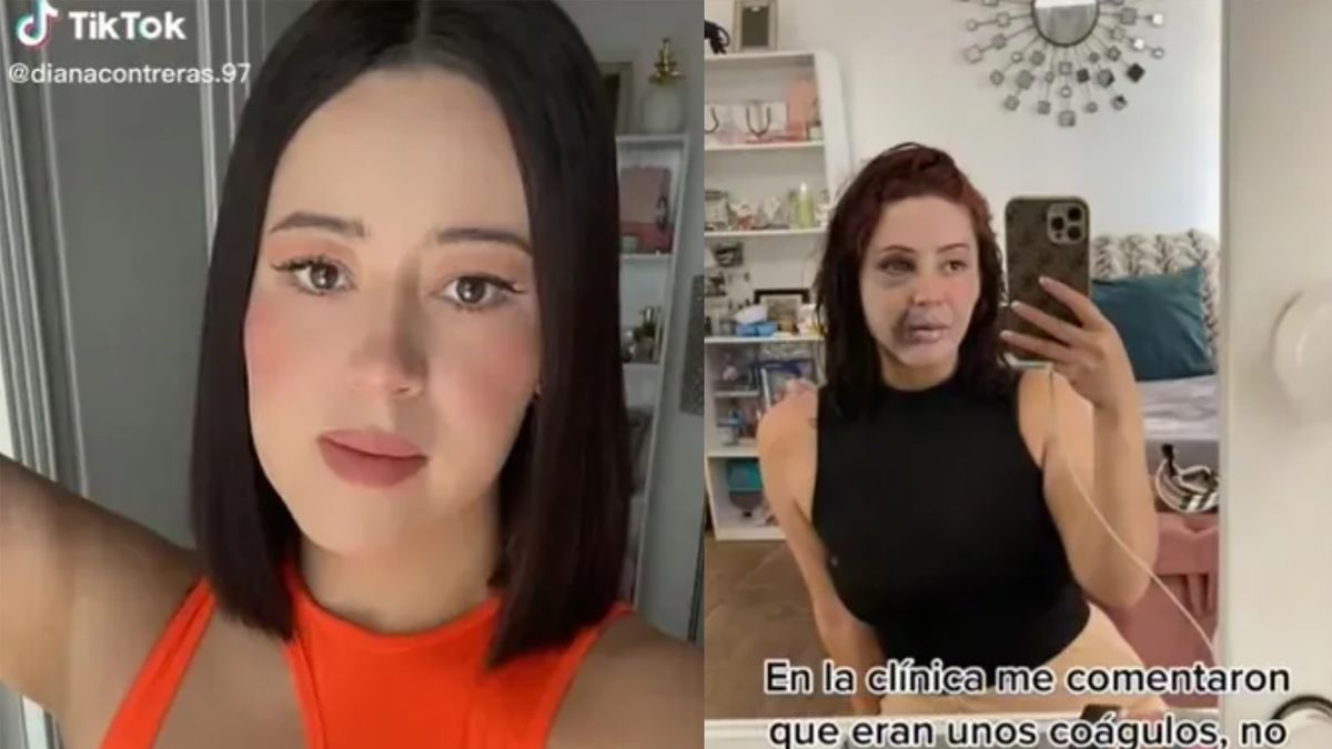 porque se forma la papada｜Búsqueda de TikTok