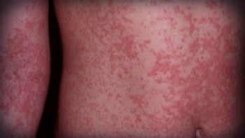 zika: el 80% con erupciones en la piel zika: el 80% con erupciones en la piel