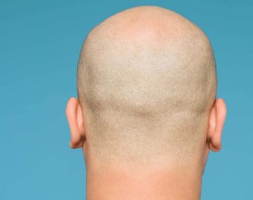 Afirman que los calvos tienen 40% más de probabilidades de padecer síntomas graves