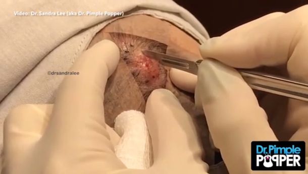Dr Pimple Popper extrañe un muñeco de nieve de un hombre