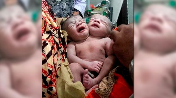 Conmoción en Bangladesh por el nacimiento de una beba con dos cabezas