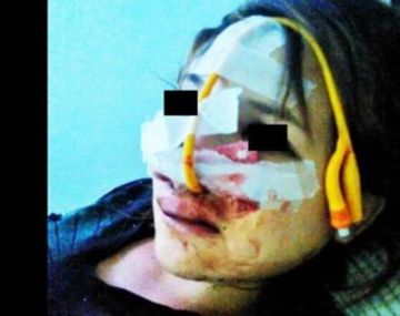 Pusieron custodia a la joven desfigurada por su novio por abrir una cuenta en Facebook