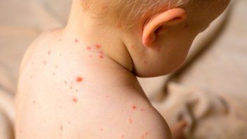 el ministerio de salud detecto un caso de sarampion en entre rios y activo una alerta nacional el ministerio de salud detecto un caso de sarampion en entre rios y activo una alerta nacional