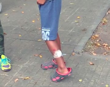 La Plata: un perro pitbull atacó a un nene de 10 años y sigue suelto en el barrio