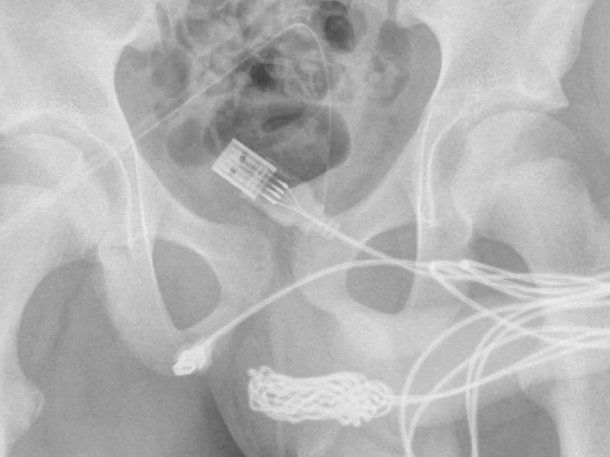 Se le atascó un cable USB en el pene: ¿qué tuvieron que hacer los médicos?