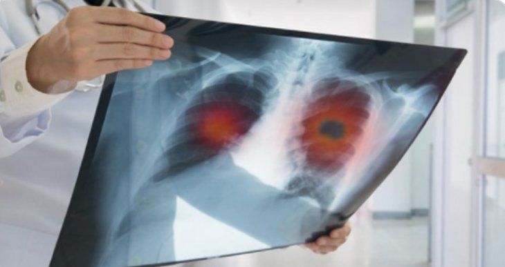 pulmonesjpg