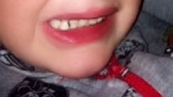 Jay Watson estuvo cinco días con un ojo pegado Jay Watson estuvo cinco días con un ojo pegado