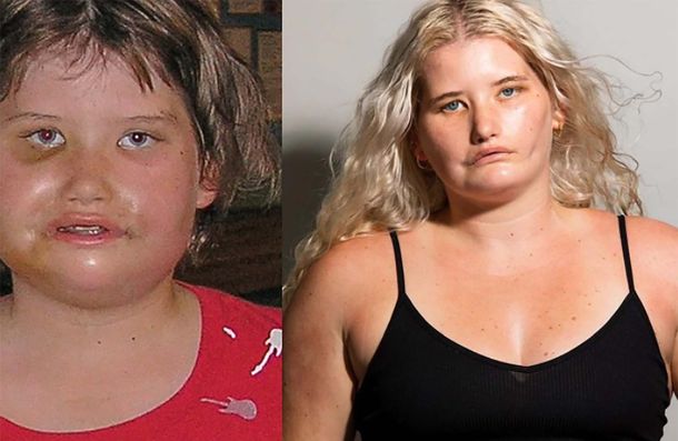 De sufrir bullying a ser modelo: el caso de la joven que no puede sonreír