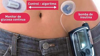 el primer pancreas artificial es argentino el primer pancreas artificial es argentino