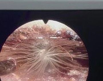 Un diente de león crece en el oído de una bebé de 16 meses