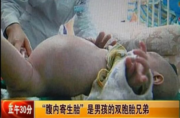 Niño de 2 años estuvo embarazado de su hermano mellizo