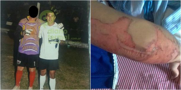 Mauricio El Torito González y el brazo herido de su pareja