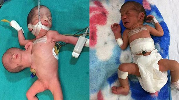 Los médicos tuvieron que liberarla de su gemelo parasitario