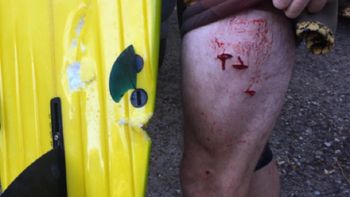 La mordida del tiburón en el muslo del surfista La mordida del tiburón en el muslo del surfista