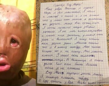 Un niño quemado le escribió una carta a Papá Noel para pedirle una cara nueva