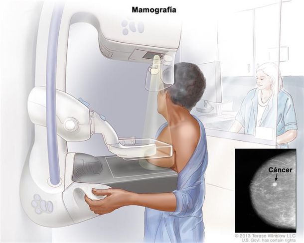 Cáncer de mama: diagnostican dos nuevos casos por hora en Argentina