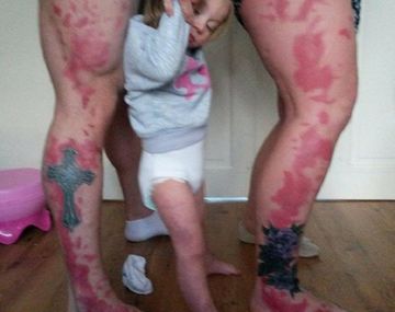 Se tatuaron las manchas de su hija
