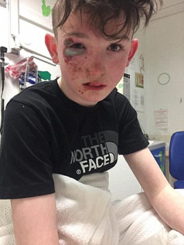 Se quemaron con un peligroso químico y dijeron que los habían atacado