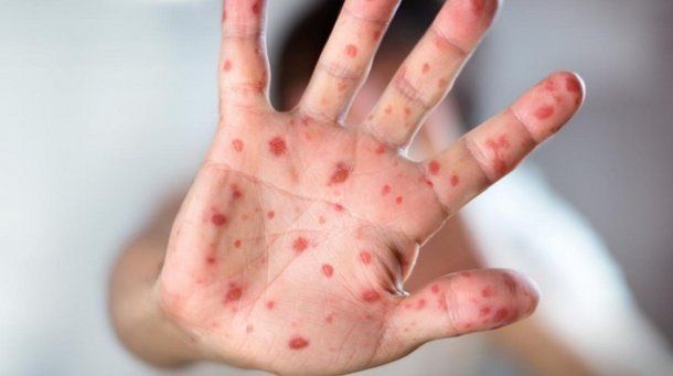 Hay alerta epidemiológica en la Ciudad por un caso de rubéola