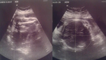 La madre asegura que en la ecografía se veían a dos bebés. Foto: canal 10. La madre asegura que en la ecografía se veían a dos bebés. Foto: canal 10.