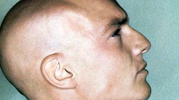 un medicamento contra la artritis podria ser la clave para solucionar la calvicie un medicamento contra la artritis podria ser la clave para solucionar la calvicie