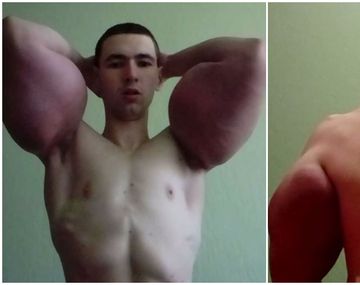 Se quería parecer a Popeye y se inyectó aceite en los bíceps