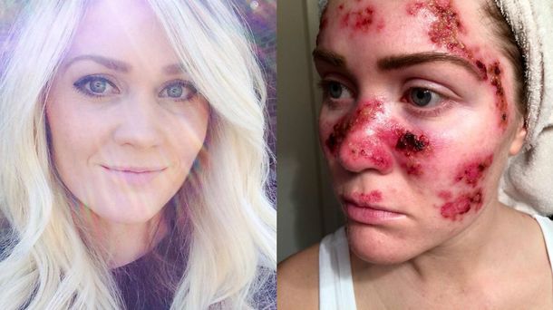Solía ir a la cama solar hasta cinco veces por semana, sufrió cáncer de piel y hoy muestra las consecuencias