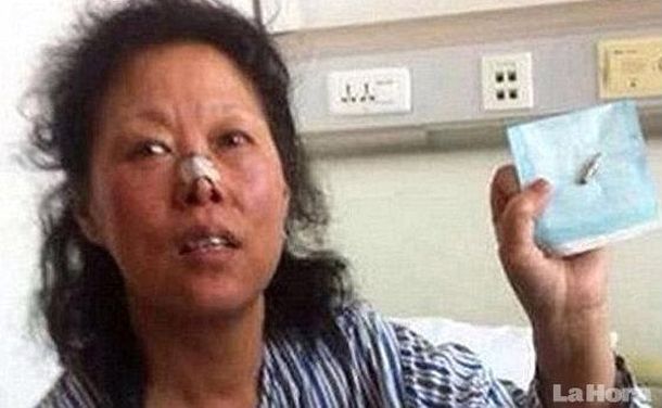 Una mujer vivió 48 años con una bala en la cabeza