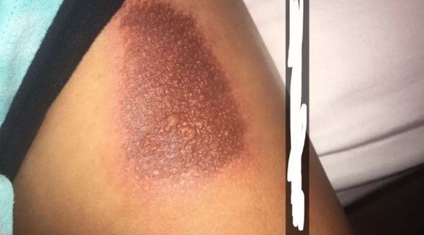 Reportan que las fundas con brillantina y líquido queman la piel de usuarios