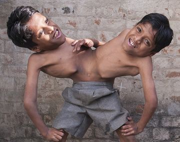 Son siameses y se niegan a ser separados porque en su país los adoran como dioses