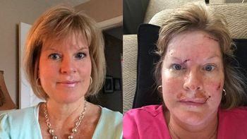 una mujer mostro las fotos impresionantes de su lucha contra el cancer de piel una mujer mostro las fotos impresionantes de su lucha contra el cancer de piel