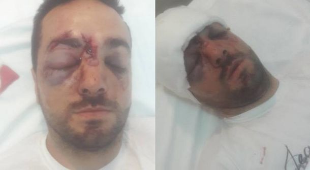 Lo golpearon con un palo en la cabeza para robarle la moto