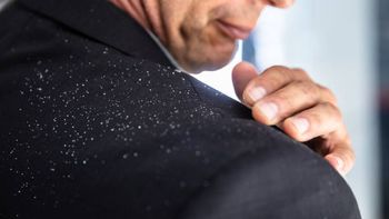 Cómo eliminar la caspa a partir de un método casero Cómo eliminar la caspa a partir de un método casero