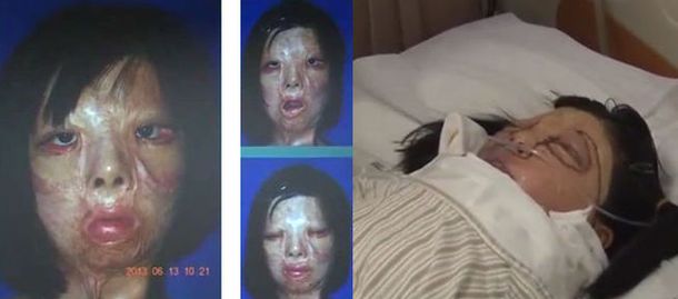 Una chica de 17 años se hizo un trasplante de cara