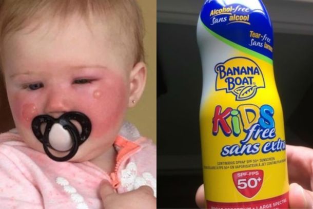 Un protector solar le provocó quemaduras
