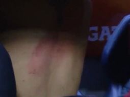 el medico de river: tienen quemaduras de primer grado el medico de river: tienen quemaduras de primer grado