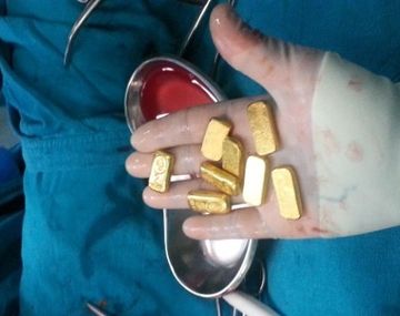Lo operaron de urgencia por dolor abdominal y le encontraron un tesoro