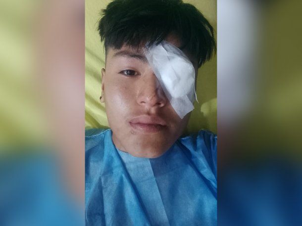 Represión en Jujuy: un adolescente de 17 años perdió un ojo por las balas de goma