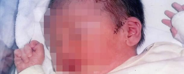 Médicos casi le amputan la oreja a un bebé en medio de una cesárea