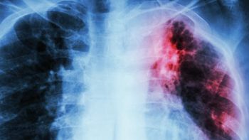 La UBA desarrolla una estrategia innovadora contra la Tuberculosis La UBA desarrolla una estrategia innovadora contra la Tuberculosis