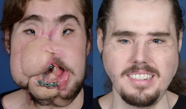 Así se ve hoy el hombre con el trasplante de cara más avanzado del mundo