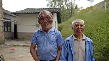 Xia Yuanhai sufre hiperplasia facial Xia Yuanhai sufre hiperplasia facial