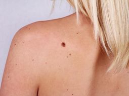Melanoma