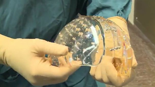 Sustituyen el cráneo de una mujer con uno plástico impreso con tecnología 3D