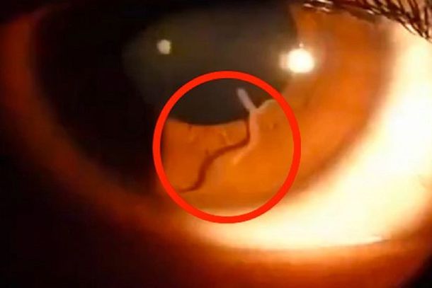 VIDEO: mirá el gusano que tenía una mujer dentro de su ojo