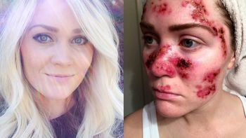 solia ir a la cama solar cinco veces por semana, sufrio cancer y muestra el dano solia ir a la cama solar cinco veces por semana, sufrio cancer y muestra el dano