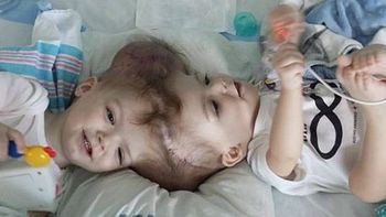 Separaron en Nueva York a dos siameses unidos por la cabeza Separaron en Nueva York a dos siameses unidos por la cabeza