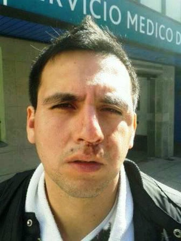 Patovica le fracturó el maxilar a un futbolista en Lanús