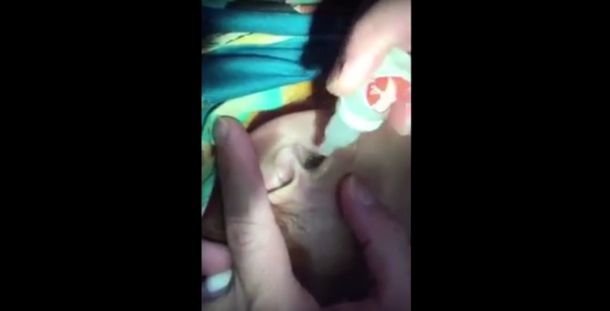 No apto para impresionables: así le sacan un ciempiés de la oreja a una nena